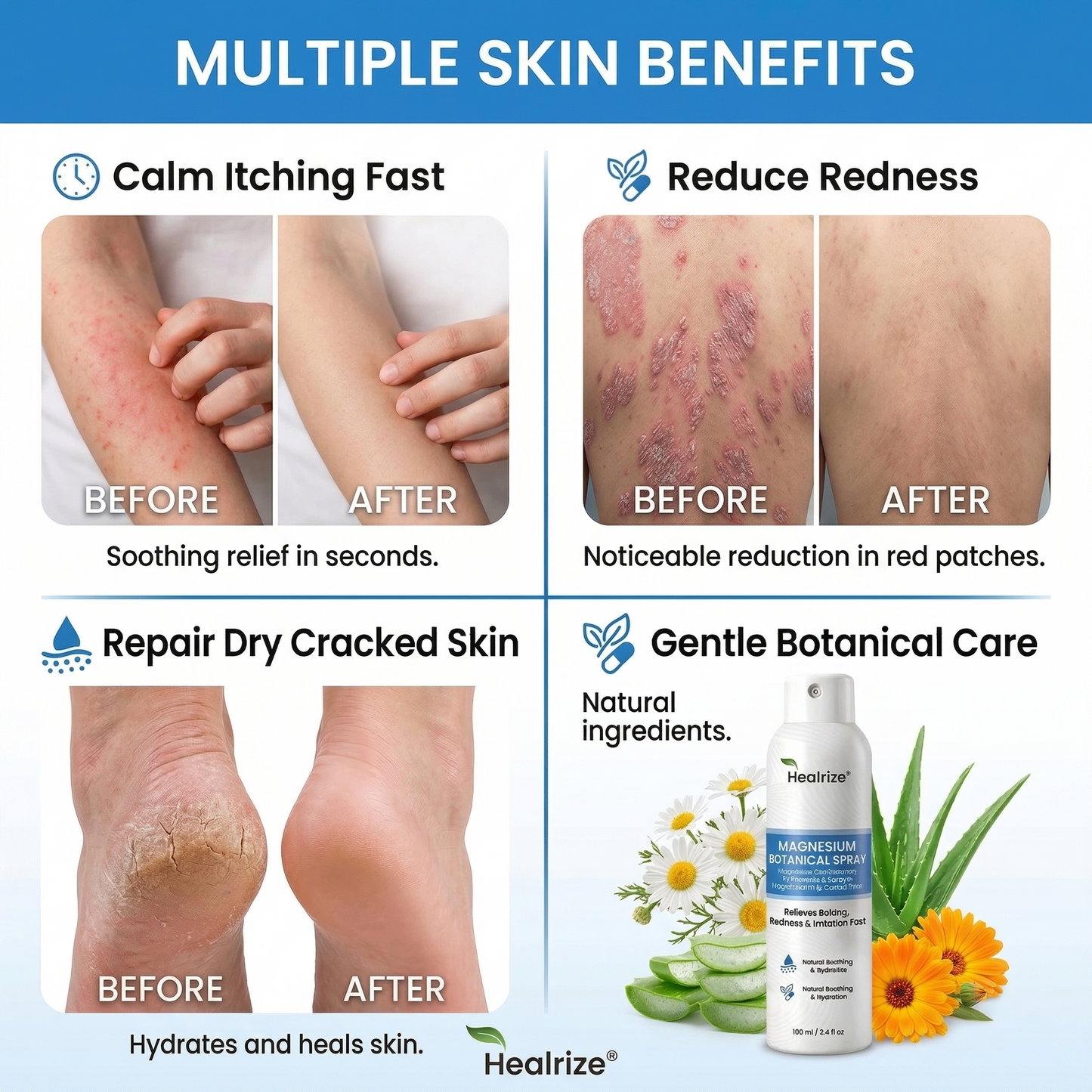 `Healrize® Magnesium Botanical Spray – Advanced Skin Recovery for Psoriasis & Eczema | Rapid Soothing, Steroid-Free