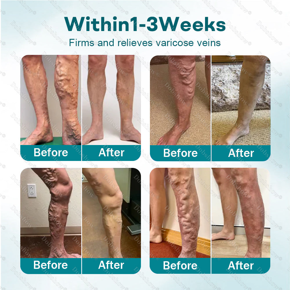 🔥Best Seller✅Healrize® Rapid Vein Relief Microdarts | 7-Day Visible & ALL SKIN TYPES 🎉Special limited-time discount