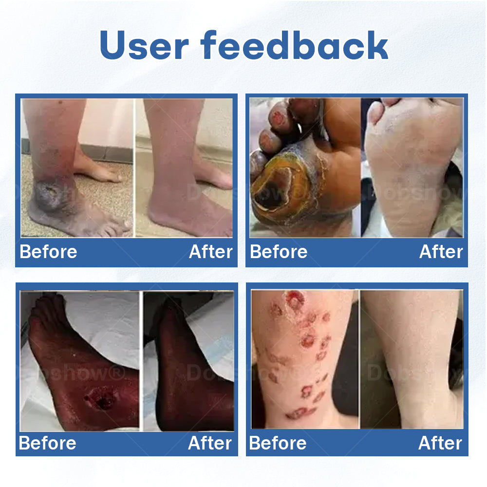 Healrize®  DiabeticFoot UicerHealing Cream