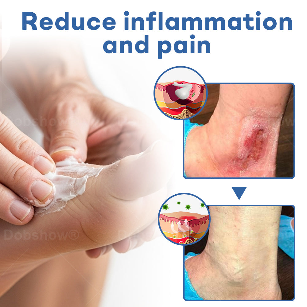 Healrize®  DiabeticFoot UicerHealing Cream